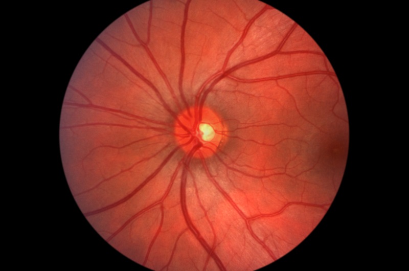 Optic Disc Photography