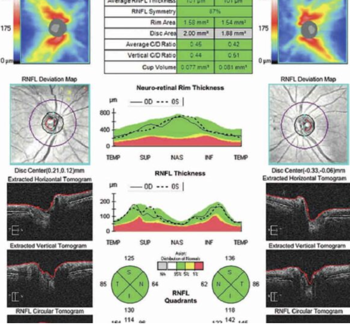 Optical Coherence Tomography