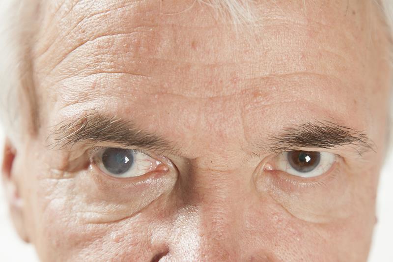 Cataract Surgery